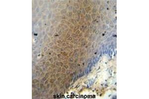 CEP70 antibody (Center) immunohistochemistry analysis in formalin fixed and paraffin embedded human skin carcinoma followed by peroxidase conjugation of the secondary antibody and DAB staining. (CEP70 anticorps  (Middle Region))