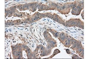 Immunohistochemical staining of paraffin-embedded Adenocarcinoma of Human colon tissue using anti-KHK mouse monoclonal antibody. (Ketohexokinase anticorps)
