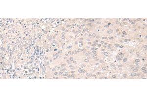 Immunohistochemistry of paraffin-embedded Human cervical cancer tissue using FOXRED2 Polyclonal Antibody at dilution of 1:35(x200) (FOXRED2 anticorps)