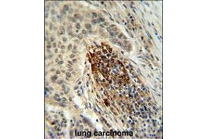 MFAP4 Antibody IHC analysis in formalin fixed and paraffin embedded human lung carcinoma followed by peroxidase conjugation of the secondary antibody and DAB staining. (MFAP4 anticorps  (C-Term))