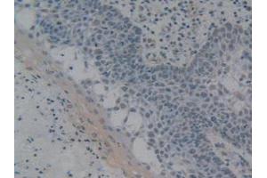 IHC-P analysis of Human Skin Cancer Tissue, with DAB staining. (HMGB1 anticorps  (AA 9-163))