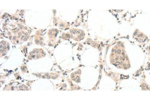 Immunohistochemistry of paraffin-embedded Human breast cancer tissue using TSPYL2 Polyclonal Antibody at dilution 1:30 (TSPY-Like 2 anticorps)