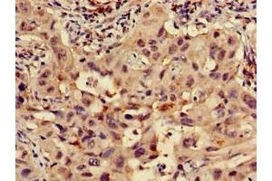 Immunohistochemistry of paraffin-embedded human lung cancer using ABIN7142496 at dilution of 1:100