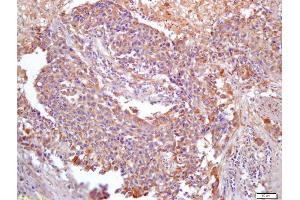 Formalin-fixed and paraffin embedded human lung carcinoma labeled with Anti-PER2/Period circadian protein 2 Polyclonal Antibody, Unconjugated (ABIN872716) at 1:200 followed by conjugation to the secondary antibody and DAB staining (ANKRD1 anticorps  (AA 185-319))