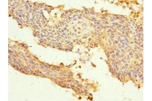 Immunohistochemistry of paraffin-embedded human cervical cancer using ABIN7174151 at dilution of 1:100