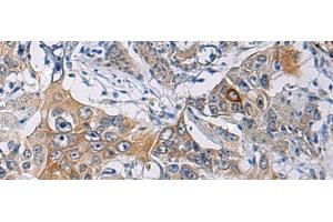 Immunohistochemistry of paraffin-embedded Human esophagus cancer tissue using KCNJ10 Polyclonal Antibody at dilution of 1:60(x200) (KCNJ10 anticorps)