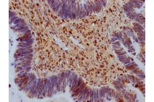 IHC image of ABIN7149714 diluted at 1:100 and staining in paraffin-embedded human ovarian cancer performed on a Leica BondTM system.