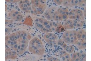 Detection of FGg in Human Liver cancer Tissue using Polyclonal Antibody to Fibrinogen Gamma (FGg)