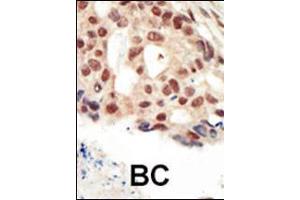 Formalin-fixed and paraffin-embedded human cancer tissue reacted with the primary antibody, which was peroxidase-conjugated to the secondary antibody, followed by AEC staining. (PRKG2 anticorps  (C-Term))