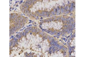Immunohistochemistry of paraffin-embedded Human rectal cancer using TNFRSF1B Polyclonal Antibody at dilution of 1:200 (40x lens). (TNFRSF1B anticorps)