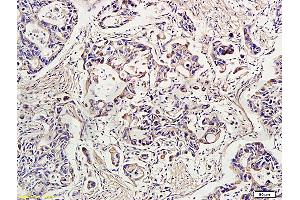 Formalin-fixed and paraffin-embedded human gastric carcinoma labeled with Rabbit Anti-IDE Polyclonal Antibody, Unconjugated (ABIN723680) at 1:300 followed by conjugation to the secondary antibody and DAB staining (IDE anticorps  (AA 491-590))