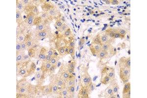 Immunohistochemistry of paraffin-embedded Human liver cancer using SULT2B1 Polyclonal Antibody at dilution of 1:100 (40x lens). (SULT2B1 anticorps)