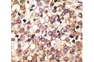 IHC analysis of FFPE human hepatocarcinoma tissue stained with the anti-TLR2 antibody (TLR2 anticorps  (AA 720-749))