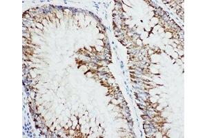 IHC-P: MAP3K1 antibody testing of human intestine cancer
