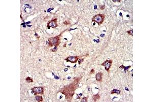 |Immunohistochemistry of paraffin-embedded human brain cancer tissue using GSNantibody. (Gelsolin anticorps  (C-Term))