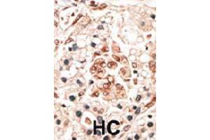 Formalin-fixed and paraffin-embedded human hepatocellular carcinoma tissue reacted with the HPCA polyclonal antibody  , which was peroxidase-conjugated to the secondary antibody, followed by DAB staining. (Hippocalcin anticorps  (N-Term))