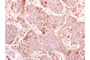 IHC-P Image MDA5 antibody [N2C1], Internal detects MDA5 protein at cytoplasm on human breast carcinoma by immunohistochemical analysis. (IFIH1 anticorps)