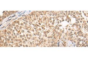Immunohistochemistry of paraffin-embedded Human ovarian cancer tissue using CABIN1 Polyclonal Antibody at dilution of 1:50(x200)