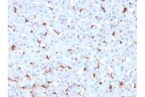 Formalin-fixed, paraffin-embedded human Hepatocellular Carcinoma stained with C1QB Mouse Monoclonal Antibody (C1QB/2961). (C1QB anticorps  (AA 41-188))