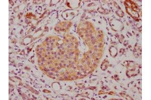 IHC image of ABIN7147174 diluted at 1:500 and staining in paraffin-embedded human lung cancer tissue performed on a Leica BondTM system.