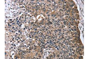 The image on the left is immunohistochemistry of paraffin-embedded Human esophagus cancer tissue using ABIN7130829(RASSF7 Antibody) at dilution 1/45, on the right is treated with fusion protein.