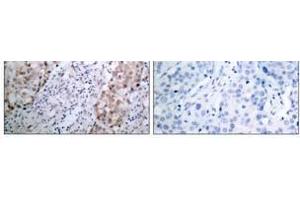 Immunohistochemical analysis of paraffin- embedded human breast carcinoma tissue using HER2 (phospho-Tyr1221/Tyr1222) antibody (E011076). (ErbB2/Her2 anticorps  (pTyr1221, pTyr1222))