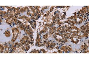 Immunohistochemistry of paraffin-embedded Human thyroid cancer tissue using GRK1 Polyclonal Antibody at dilution 1:40