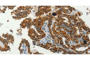 Immunohistochemistry of paraffin-embedded Human thyroid cancer using SERPINA9 Polyclonal Antibody at dilution of 1:60 (SERPINA9 anticorps)