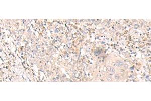 Immunohistochemistry of paraffin-embedded Human cervical cancer tissue using IL24 Polyclonal Antibody at dilution of 1:30(x200) (IL-24 anticorps)