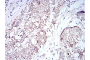 Immunohistochemical analysis of paraffin-embedded bladder cancer tissues using RND3 mouse mAb with DAB staining.