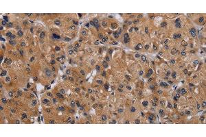 Immunohistochemistry of paraffin-embedded Human liver cancer using GNAS Polyclonal Antibody at dilution of 1:30