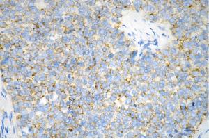 Immunohistochemistry was performed on paraffin-embedded human breast carcinoma using hexokinase 1 antibody (ABIN7798906), 1:200).