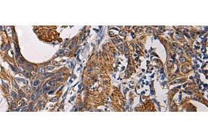 Immunohistochemistry of paraffin-embedded Human esophagus cancer tissue using SSH3 Polyclonal Antibody at dilution of 1:60(x200)