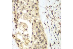 Immunohistochemistry of paraffin-embedded human lung cancer using FGFR1 antibody at dilution of 1:100 (400x lens). (FGFR1 anticorps)