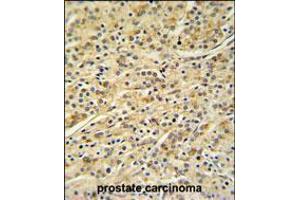 HOXA3 Antibody IHC analysis in formalin fixed and paraffin embedded prostate carcinoma followed by peroxidase conjugation of the secondary antibody and DAB staining. (HOXA3 anticorps  (C-Term))