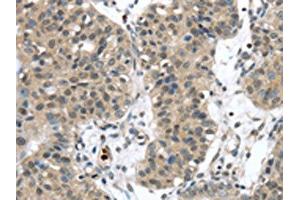 The image on the left is immunohistochemistry of paraffin-embedded Human breast cancer tissue using ABIN7192310(SENP6 Antibody) at dilution 1/20, on the right is treated with synthetic peptide.