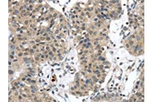 The image on the left is immunohistochemistry of paraffin-embedded Human breast cancer tissue using ABIN7192310(SENP6 Antibody) at dilution 1/20, on the right is treated with synthetic peptide. (SENP6 anticorps)