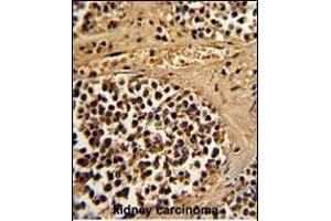 Formalin-fixed and paraffin-embedded human kidney carcinoma reacted with ESRRA Antibody (Center), which was peroxidase-conjugated to the secondary antibody, followed by DAB staining. (ESRRA anticorps  (AA 131-159))