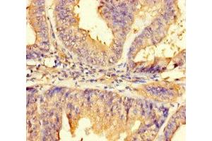 Immunohistochemistry of paraffin-embedded human endometrial cancer using ABIN7165645 at dilution of 1:100
