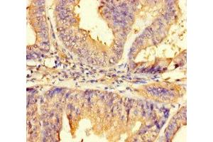 Immunohistochemistry of paraffin-embedded human endometrial cancer using ABIN7165645 at dilution of 1:100 (IMPACT anticorps  (AA 41-320))