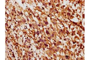 IHC image of ABIN7160617 diluted at 1:400 and staining in paraffin-embedded human melanoma performed on a Leica BondTM system. (MYO3B anticorps  (AA 1110-1276))