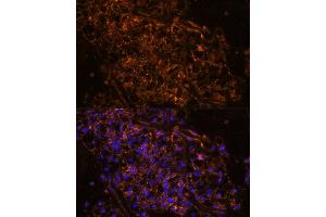 Immunofluorescence analysis of human kidney cancer using SCNN1G antibody (ABIN7270387) at dilution of 1:100. (SCNN1G anticorps  (AA 100-250))
