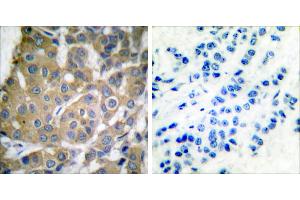 Peptide - +Immunohistochemical analysis of paraffin-embedded human breast carcinoma tissue using Cox2 antibody. (COX2 anticorps)