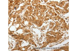 Immunohistochemistry of Human gastric cancer using TGFBR1 Polyclonal Antibody at dilution of 1:60