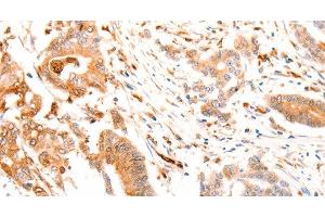 Immunohistochemistry of paraffin-embedded Human colon cancer tissue using ABCA4 Polyclonal Antibody at dilution of 1:30