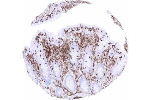 In the appendix CD45 immunostaining is stronger in lymphocytes than in macrophages.