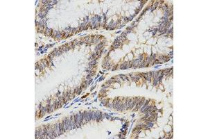 Immunohistochemistry of paraffin-embedded human rectal cancer tissue using TPM2 antibody at dilution of 1:200 (x400 lens)