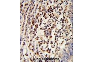 Formalin-fixed and paraffin-embedded human lung carcinoma reacted with MOSC2 Antibody (C-term), which was peroxidase-conjugated to the secondary antibody, followed by DAB staining.