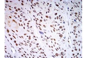 Immunohistochemical analysis of paraffin-embedded esophageal cancer tissues using KDM1A mouse mAb with DAB staining.