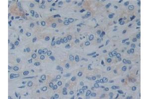 IHC-P analysis of Human Prostate cancer Tissue, with DAB staining. (Reelin anticorps  (AA 2398-2608))
